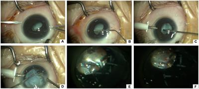 Cyanoacrylate glue for iatrogenic retinal breaks during vitrectomy in stage 5 familial exudative vitreoretinopathy